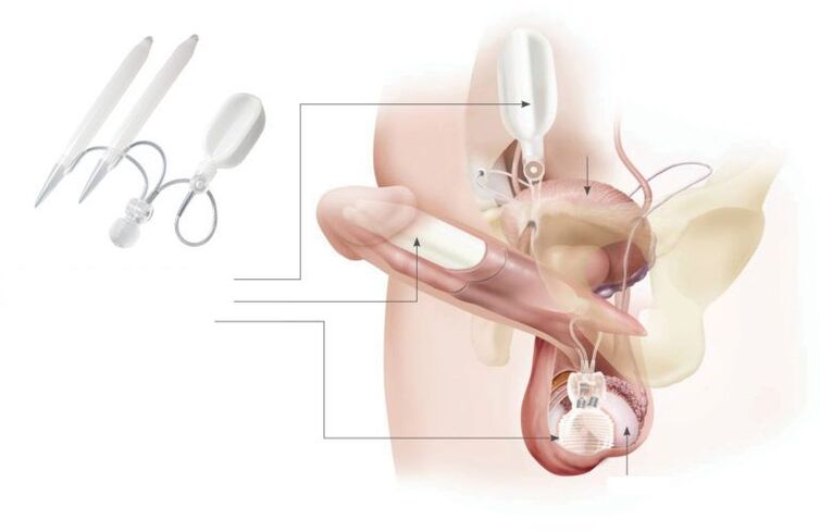 Implantes de xel no pene